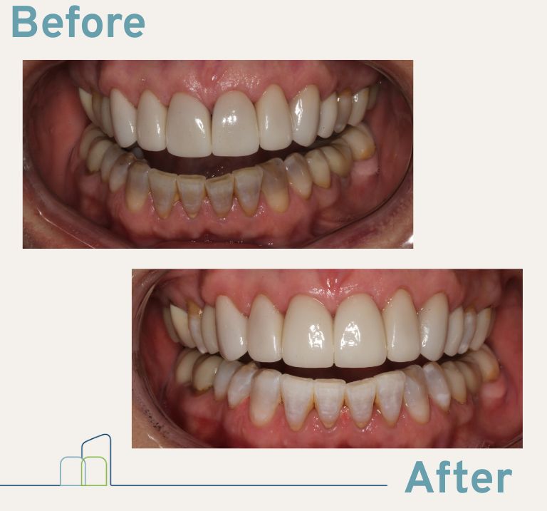 KoR Teeth Whitening Results_Before and After results for tetracycline staining at West End Dental